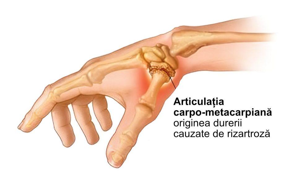 rizartroza mainii