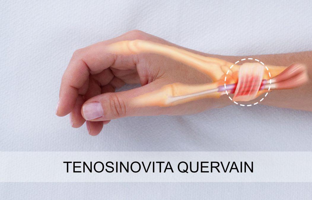 Tenosinovita Quervain